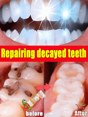 Repair tooth